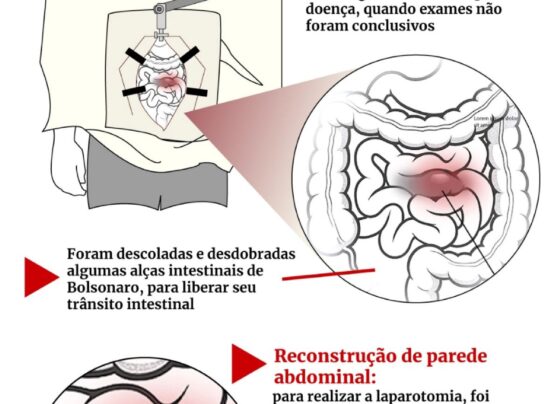 obstrução intestinal