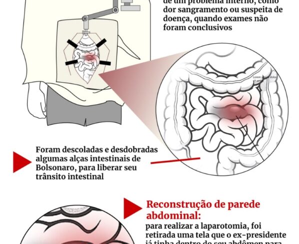 obstrução intestinal