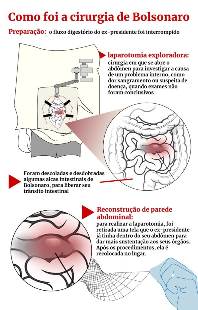 obstrução intestinal